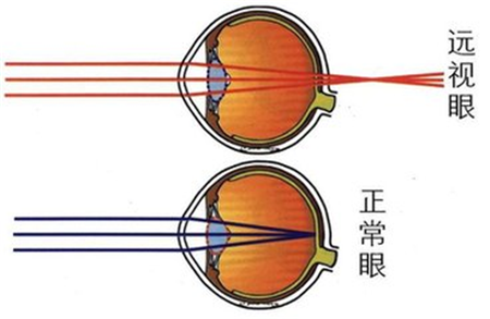 远视,怎么,矫正,三种,方式,如果,看见,一个人,