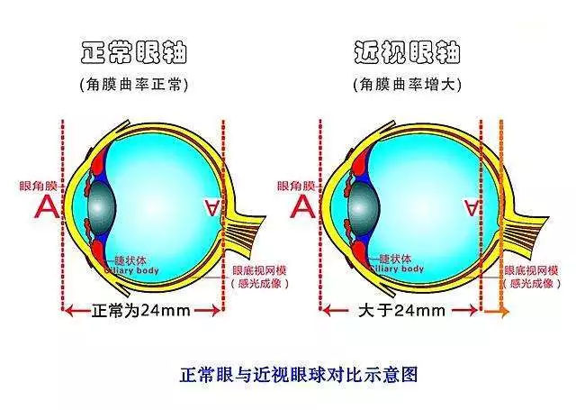 正常眼与近视眼